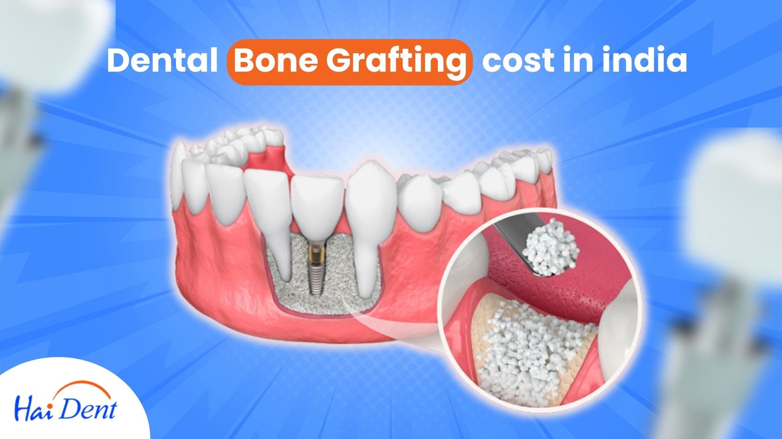 Bone Grafting cost in India